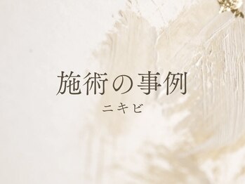 白雲木/施術の事例　ニキビ