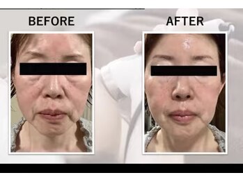 リラックス(Relax)/シェービング×エクソソーム導入