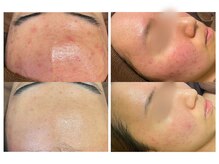 ビオエル 横浜店(Bioel)の雰囲気（リベル・REVIのハーブピーリングでお肌のお悩みにアプローチ！）