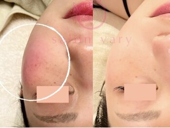 サロンヴェアリー 広尾(salon vary)/赤ら顔にはテクスパ&白玉