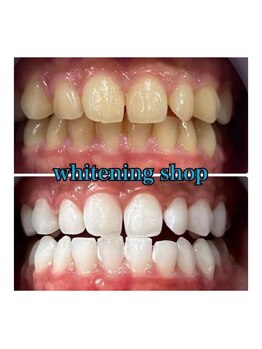 ホワイトニングショップ 所沢店/before&after美白ホワイトニング