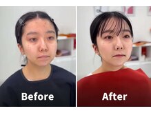 ルミエルスタイル 上野御徒町店(LUMIEL STYLE)/イエベ秋のお客様 BEFORE→AFTER