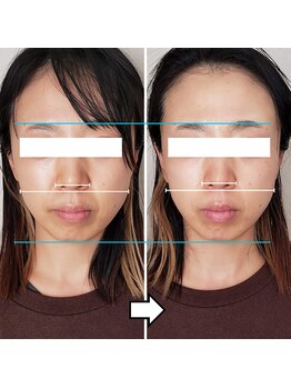 きしの美容整体院/フェイシャルリフトケアBA