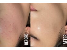 ダイアナギンザ(DIANA.GINZA)の雰囲気（毛穴洗浄専門店で徹底施術♪）