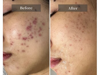 エミルカ 天王寺店(EMILUCA)/しつこいニキビもキレイに