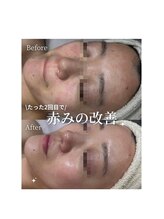 ココリール/赤み・乾燥肌改善