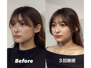 コルミチョン サロン(骨美整 salon)/Before・After(エラ張り)