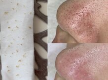 ミスター(Mr.)の雰囲気（毛穴エクストラクションで鼻の黒ずみ解決◎）