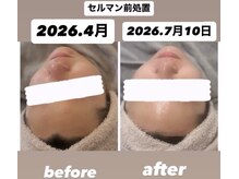 エルカ(eluca)の雰囲気(セルマンでトーンも肌質も美しく。来店初日から3か月後)