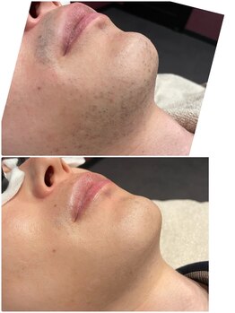 グロー(GLOW)/メンズヒゲ脱毛