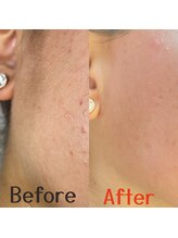 ダイア(DIA)/☆フェイシャルWAX効果☆