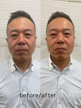 長寿鍼灸院 長寿整骨院/men's美容鍼50本効果★