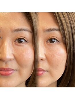 サロンドエー 帝塚山(Salon de A)/ヘッドスパでお顔のリフトアップ