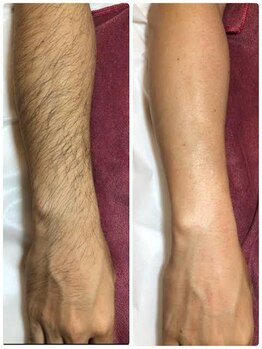 ヒュッゲサロン(HYGGE Salon)/メンズ腕脱毛の変化