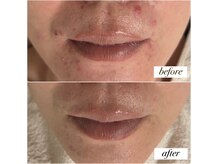 ミュー(myu)の雰囲気（繰り返す大人のニキビケアに）