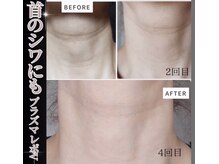 オリーブ(Olive)の雰囲気（プラズマは顔だけでなく、首のシワにも働きかけます★）
