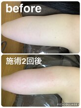 ギンザアール(GINZA R.)/すっきり二の腕に◎