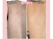 ベルミーランド 浜松天王/脱毛Before→After