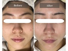 エミルカ 天王寺店(EMILUCA)/韓国肌管理