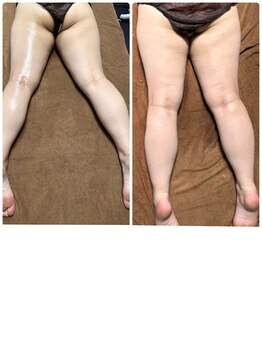 チュラ/ハイパーナイフ/所沢/痩身エステ