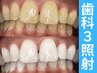 【会員/回数券】20分×3回歯科提携セルフホワイトニング