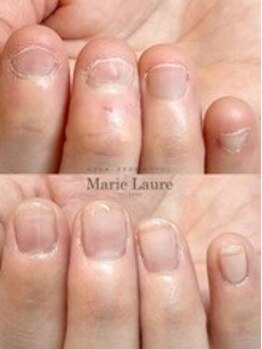 マリーロール 梅田店(Marie Laure)/自爪育成/深爪矯正/ネイルケア