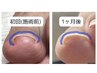 FOOT 【Newクーポン】巻き爪緩和1本 ジェルワンカラー ¥14,600 (ドライケア)