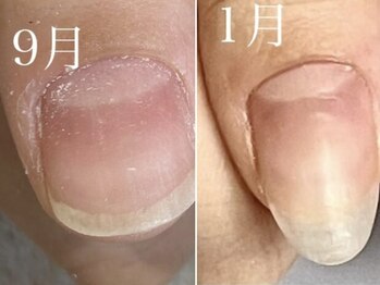 グレースレディ/4カ月後の深爪矯正