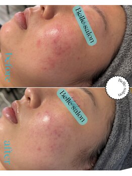 ベルサロン(Belle salon)/ニキビケア