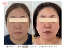 エソア(esoa)/40代　小顔矯正×レモンボトル