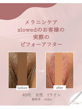 スロウド(Slowed)/人気の黒ずみケア