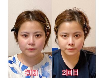 小顔22 ボルティ 赤坂支店(Bolty)/小顔シンメトリー矯正（2回目）