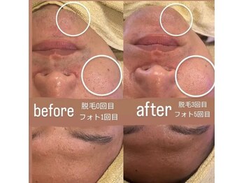 クレール 小山店(CLAIR)/【美肌フォト×ひげ脱毛】