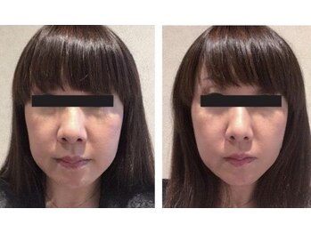 ディサイドロー(DECIDE L.A.W)/BeforeAfter