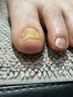 【トラブルフットネイル】剥離・肥厚ありフットネイルケア