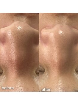 百変化/毛穴洗浄ハイドロスキン