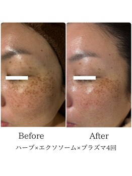 ラ セルフィー(Ra Selfee)/ハーブ×エクソソーム×プラズマ