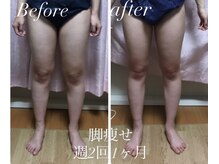 キアラ(chiara)/キャビテーション痩身