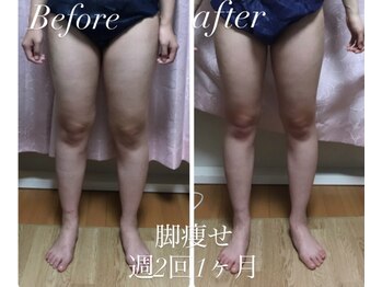 キアラ(chiara)/キャビテーション痩身