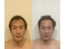 パラフューズ 札幌店 ブランジュ(PARAFUSE.)/脳洗浄before after