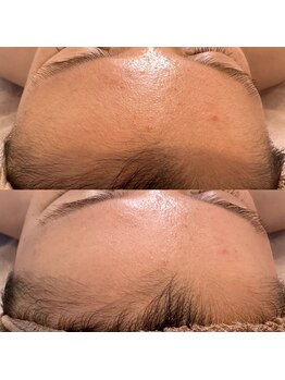 アール(ar.)/プラズマ顔脱毛（5回）