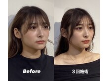 コルミチョン サロン(骨美整 salon)/Before・After(エラ張り)