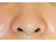 ワイキューマルサン(y903)/毛穴　after