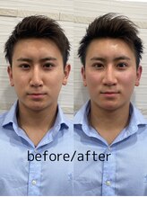 長寿鍼灸院 長寿整骨院/men's美容鍼100本効果★