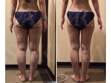 エステティックサロン サクラ(SAKURA)/むくみスッキリ！美脚GET☆