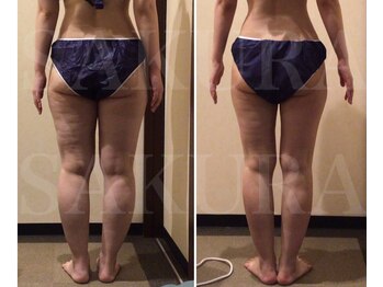 エステティックサロン サクラ(SAKURA)/むくみスッキリ！美脚GET☆