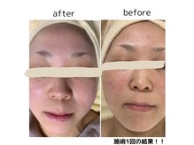 高濃度ビタミンA配合【ENVIRON】皮膚科学会出展実力の結果