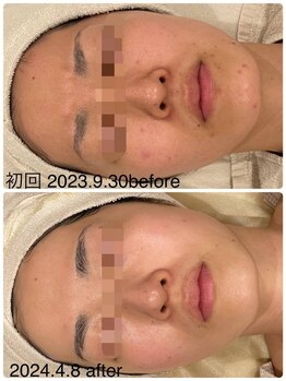 ベルミナ(BE.LMINA)/ニキビケア、毛穴の開き