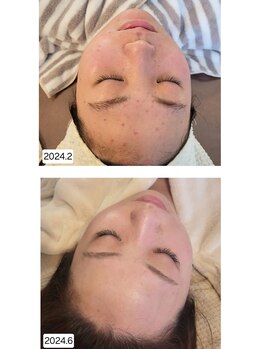 ムーフ(Moof)/施術例