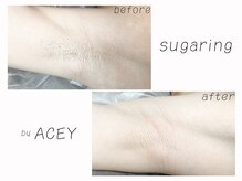 エイシー(ACEY)/ビフォーアフター☆脇